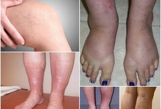 Fotoe vun Manifestatiounen vu Variikose Venen op de Been