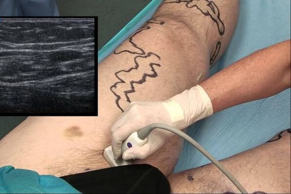Diagnos vun Krampfadern bei Männer