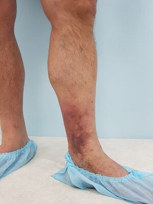 Komplikatioune vun Krampfadern bei Männer