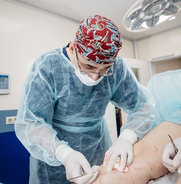 chirurgesch Behandlung vun Krampfadern