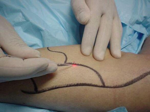 Laser Behandlung vun Krampfadern