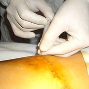 Miniphlebektomie ass déi kosmetesch Behandlung fir Krampfadern