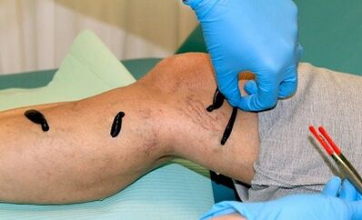 Hirudotherapie fir Variosen Venen