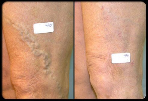 Virun an no der Chirurgie an de Venen