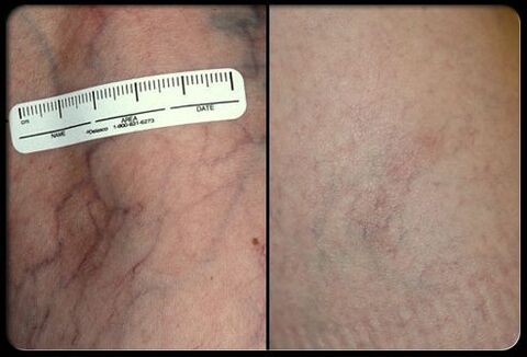 Virun an no der Laser Therapie Prozedur