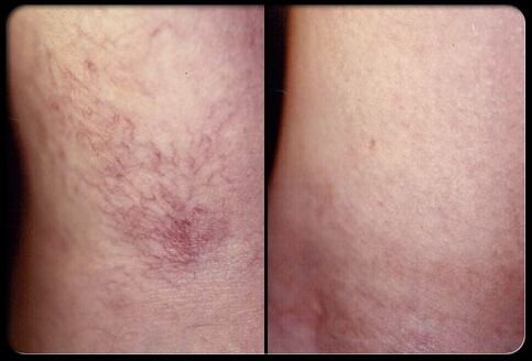 Virun an no der Sclerotherapie