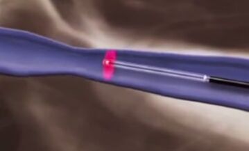 Thermesch Behandlungen